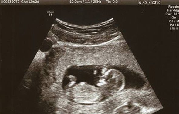 How to Make Your Fake Ultrasound Prank More Convincing